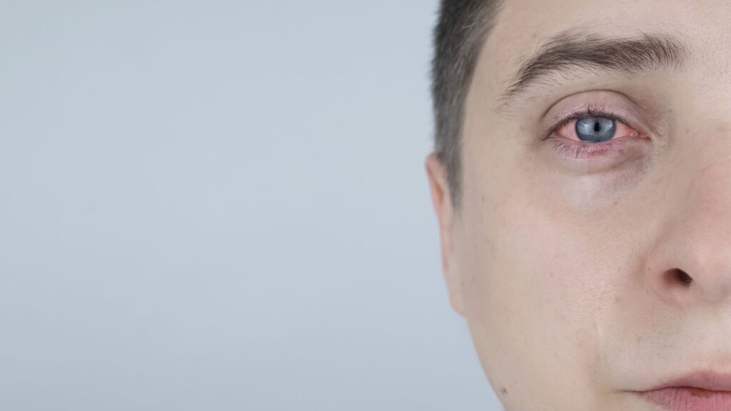 Irritación ocular